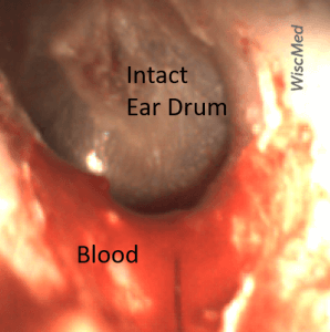 Small amounts of blood in ear canal?