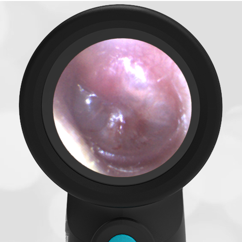 6-year-old with Ear Pain