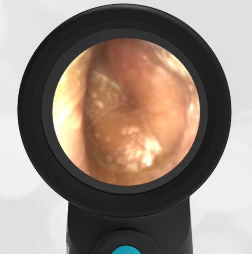 4-year-old with Ear Pain and a Fever