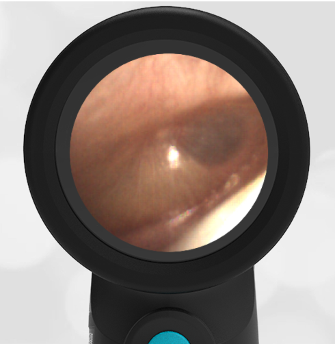 Autistic Child with history of AOM