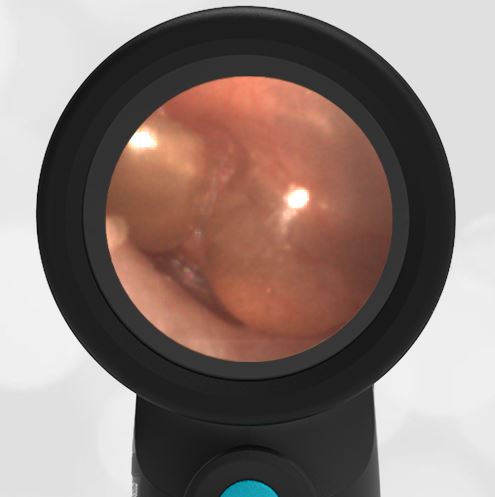 5-year old with Severe Ear Pain