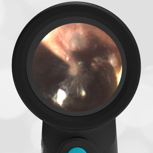 6-year-old Fall from Balcony