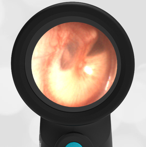 5-year-old with a Fever and Ear Pain