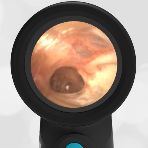 55-year-old Male with Ear Discharge