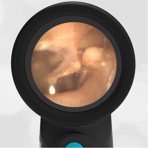 Osteoma