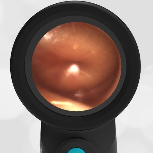 Aom Roc Acute Otitis Media (AOM) – WiscMed