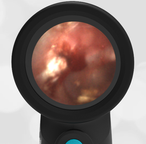 5-year-old with Ear Pain