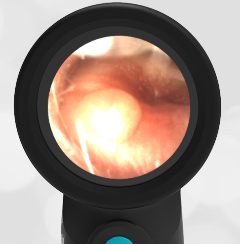 7-year-old with Ear Pain II
