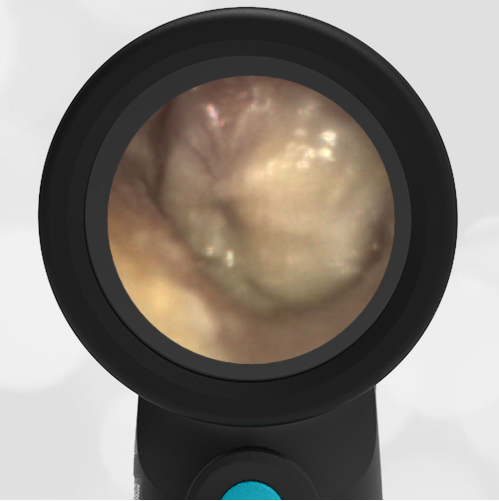 3-year-old with a Fever and Headache