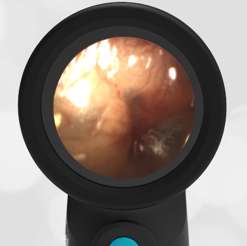 3-year-old with Ear Pain and Fever