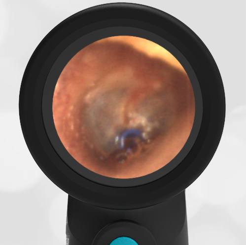 31-year-old with Decreased Hearing