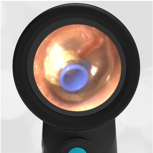 31-year-old with Decreased Hearing 2