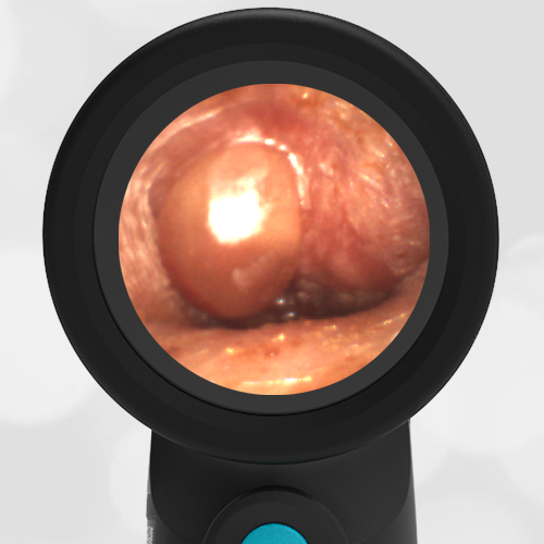 Advances In Digital Otoscopy Help Improve AOM Diagnoses