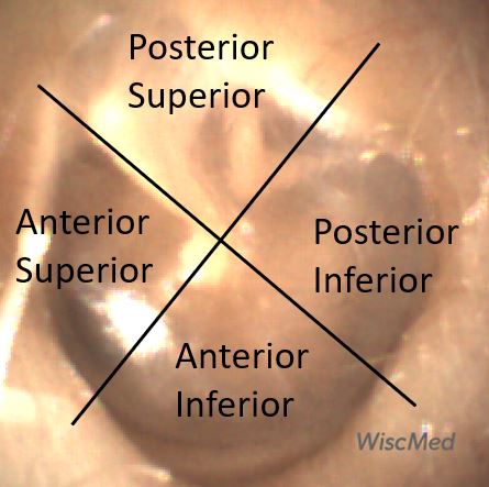 The Quadrants of the Tympanic Membrane and Their Significance