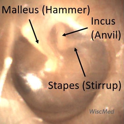 Hammer, Anvil & Stirrup by otoscopy. Bones of the middle ear.