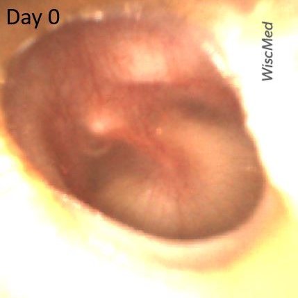 Progression to Acute Otitis Media (AOM)