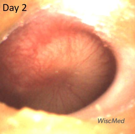 Initial Diagnosis and Resolution of Acute Otitis Media (AOM) in Images