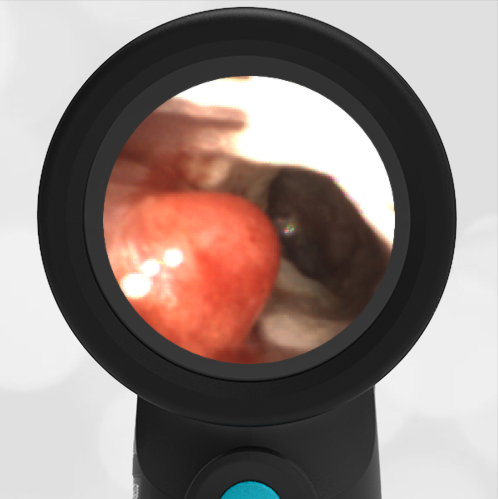 Ear Canal Polyp – WiscMed