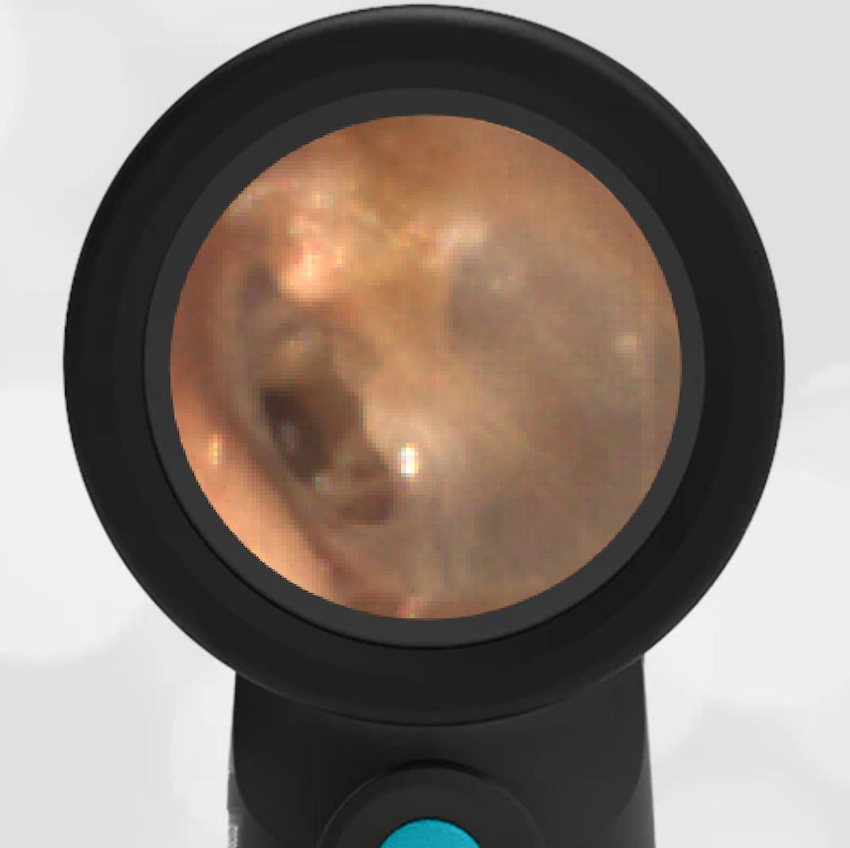 65-year-old with a History of Diving