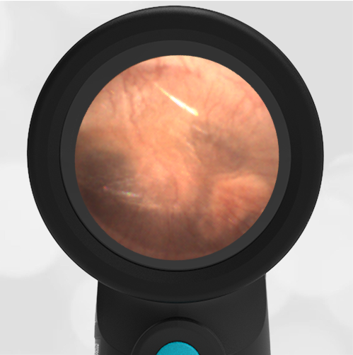 Mud Spots or Resolving Middle Ear Muco-Purulence – WiscMed