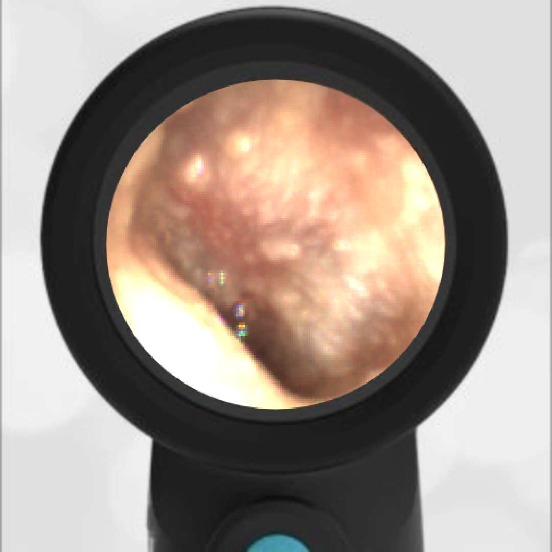 23-year-old with Ear Drainage
