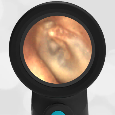 43-year-old with Ear Pain