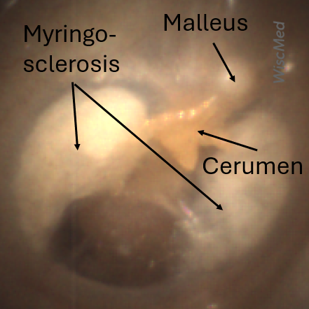 Tm Sclerosis Tympanic Membrane Sclerosis