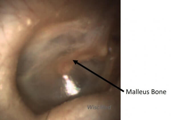 Normal Ear Anatomy - WiscMed