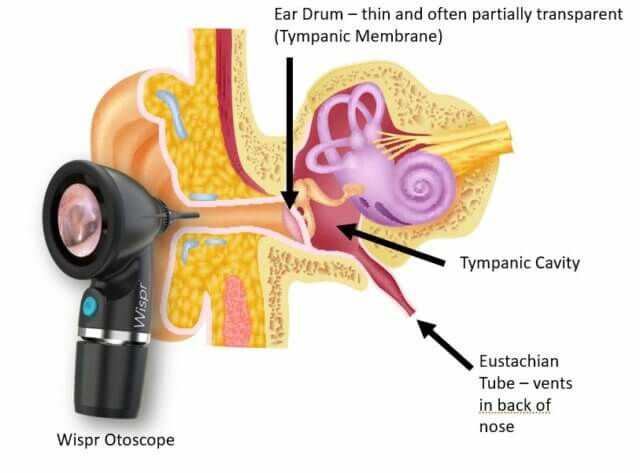 Intro to Normal Ear Anatomy as Seen by Otoscopy Illustrated- WiscMed