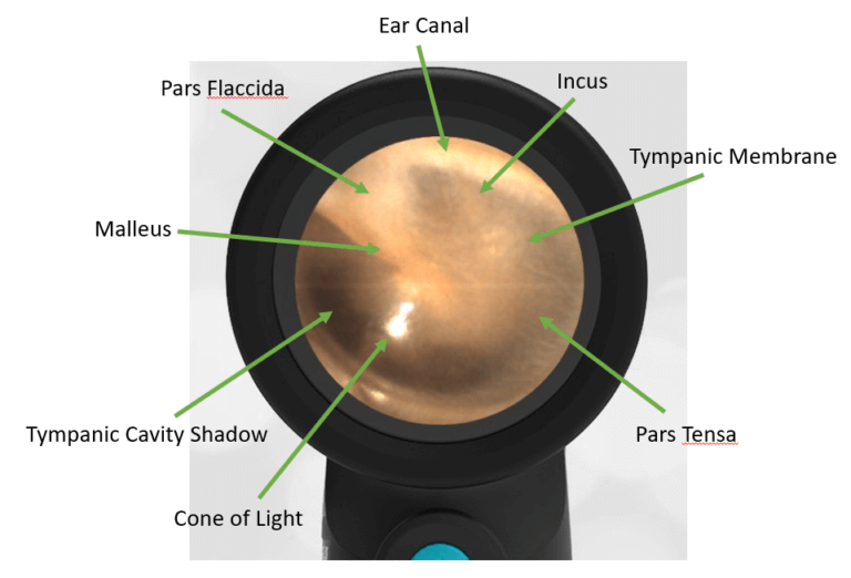 Normal Left Ear Wiscmed