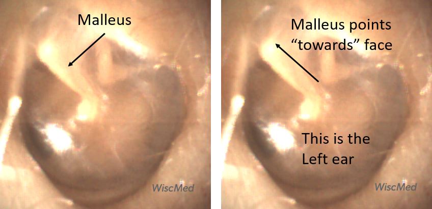 Quadrants Of The Tympanic Membrane WiscMed